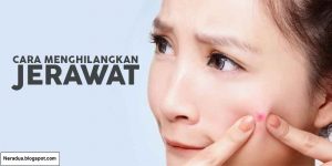 Cara menghilangkan jerawat